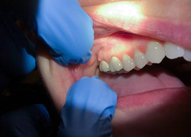 Best Knocked-Out Tooth (Avulsed Tooth) Treatment in Centrevle, IL